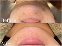 サロンドフェイス(Salon de Faith)/ハーブピーリング