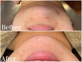 サロンドフェイス(Salon de Faith)/ハーブピーリング