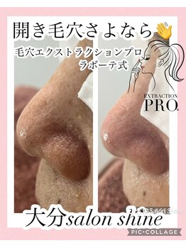 サロンシャイン(Salon Shine)/60代女性毛穴1回