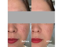 アンド(and...)/肌質改善・毛穴・産毛ケア