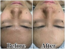 ルリアン(LeLien)/ダクトピール＋LDM 3回の効果！