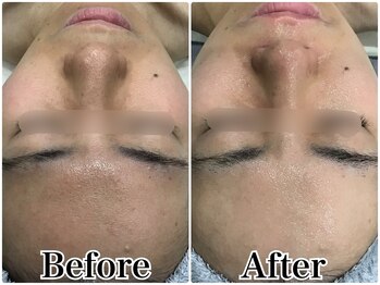 ルリアン(LeLien)/ダクトピール＋LDM 3回の効果！