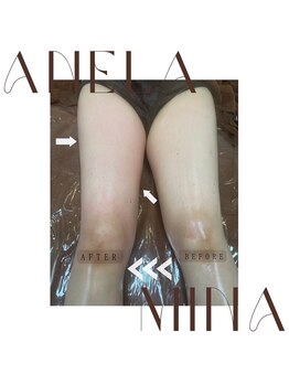 アーネラミーナ(Anela mina)/施術例