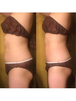 サロン ド チョコ(SALON DU CHOCO)/痩身症例