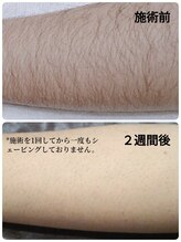 ビィオラ(Violae)/≪メンズ≫　ひじ下脱毛