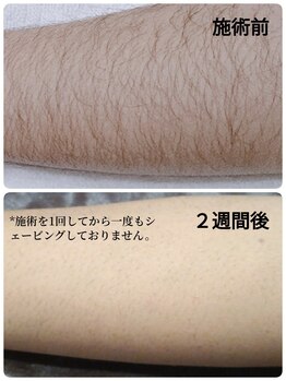 ビィオラ(Violae)/≪メンズ≫　ひじ下脱毛