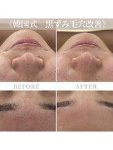 リアム(LiAm)/黒ずみ毛穴改善