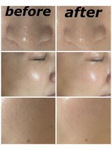 クリスタルボウ(Crystal BEAU)/Elight顔脱毛1回のみ