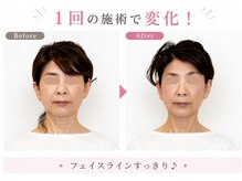 リフェイス(RE:FACE)/フェイスラインすっきり♪