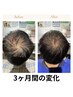 【初回限定40%オフ】頭皮診断+スカルプケア