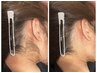 大人気！！【後ろ姿美人うなじ脱毛】まとめ髪アップヘアもスッキリ！！