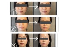 ザ ワン(THE ONE)/美zen筋骨小顔　エラ/リフトケア