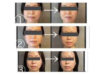 ザ ワン(THE ONE)/美zen筋骨小顔 エラ/リフトケア