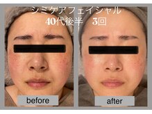 ブリノス(BLINOSS)/シミケアフェイシャル