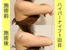 オプレア 千種店(OPREA)/ハイパーナイフ◆背中が薄く◎