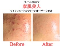 オアシス 船橋店(Oasis)/マイクロニードル☆ビフォアフ