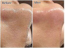 エミマス ボーテ(Emimas Beaute’)/頑固な黒ずみ毛穴もスッキリ！