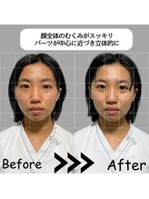 ゆしんアネックス/美容鍼のビフォーアフター♪