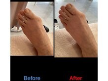 鍼灸接骨慈康院/鍼灸でリウマチ施術