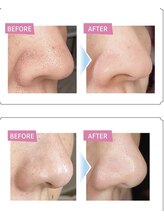 サロンヤザワ(Salon yazawa)/毛穴洗浄