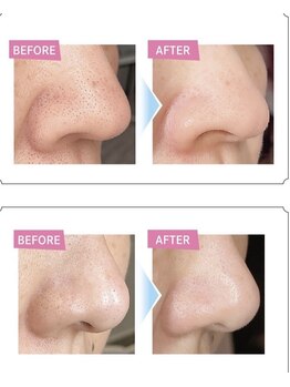 サロンヤザワ(Salon yazawa)/毛穴洗浄