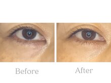 ブルースター/美容鍼×フェイシャル＊