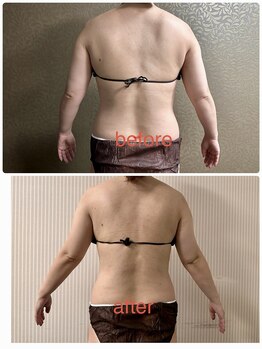 チュラ/ハイパーナイフ/所沢/痩身エステ