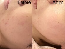 リンダ 西宮店(LINDA)/ニキビケア