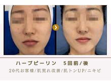 ルナビューティー 赤坂(LUNA beauty)/ 剥離させないハーブピーリング