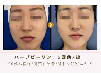 ルナビューティー 赤坂(LUNA beauty)/ 剥離させないハーブピーリング