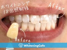 ホワイトニングカフェ 千葉店/ホワイトニング18回照射後＊男性
