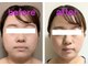 アルビス(ARVISS)の写真/【秋の小顔集中ケア】夏の疲れ顔・たるみに！NEW★脂肪分解レッドショット＋プラズマ＋小顔リンパ