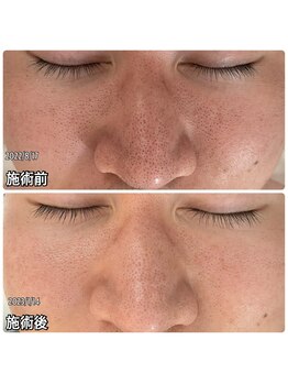 ルネ(Rune)/毛穴洗浄の効果