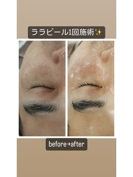 サロン ナビ(salon nabi.)/ララピールbefore→after♪