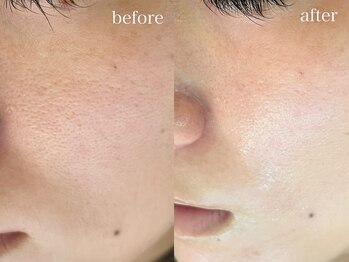 テオリア(TEORIA)/ボコボコ肌ザラザラ肌の方必見♪