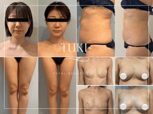 ツキ(TUKI+)の雰囲気（脂肪を増やすも減らすも自由自在★欲しいところに欲しいだけ◎）
