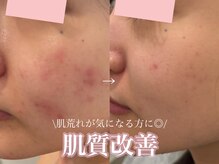 まつげエクステ専門店 クレイン(CRANE)/ハーブピーリング