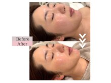 フロリール アザブジュウバン(FlorirAzabujuban)/3D小顔/造顔フェイシャル