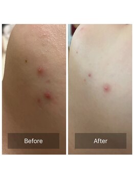 ビジュープラス 筑西下館店(Bijou+)/【20代お悩み】ニキビ/5回3ヶ月