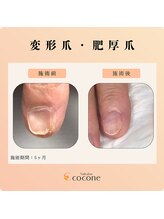 ココネ(cocone)/変形爪