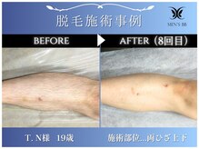 メンズビービー 福井高柳店(MEN'S BB)/ボディ脱毛施術事例