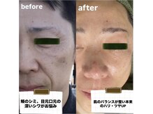 ルミエール パークサイド(L’MIERE parkside)の雰囲気（極度乾燥肌の50歳男性、継続4年でここまで肌が改善）