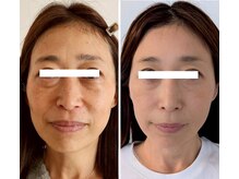 天使のしずく/４０代必見！驚きの透明感とハリ