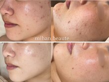 ミハン ボーテ(mihan.beaute)