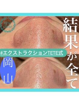 サロンこころ/1回でこの効果！毛穴ケア