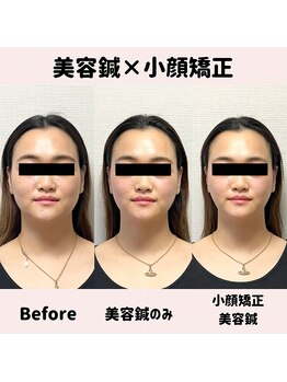ワッカ 広尾(WACCA)/美容鍼×小顔矯正BeforeAfter 1