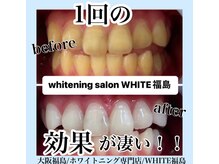 ホワイトニングサロン ホワイト(WHITE)/セルフホワイトニング/大阪/福島