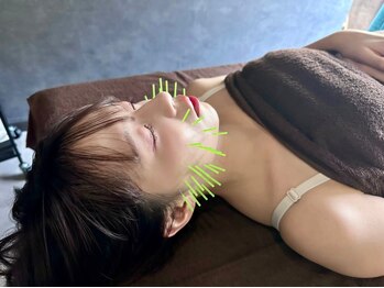 クリアランス(CLEARANCE)の写真/【平日限定】12時-17時リフトアップ美容鍼＋パルス(電気鍼)¥16500→¥8250痛みの感じにくい美容鍼☆