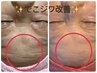 《目指せツルピカおでこ!!》女性らしい丸みのある綺麗なおでこへ大変身★