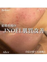 ジェノール 2nd beauty studio 姫路駅前店(JNOEL)/結果重視の肌質改善